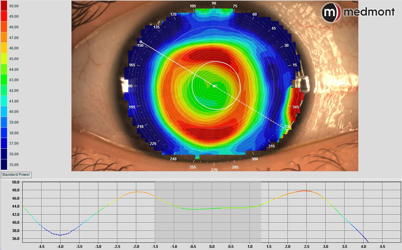 Corneal mapping and topography for orthokeratology lenses for myopia management